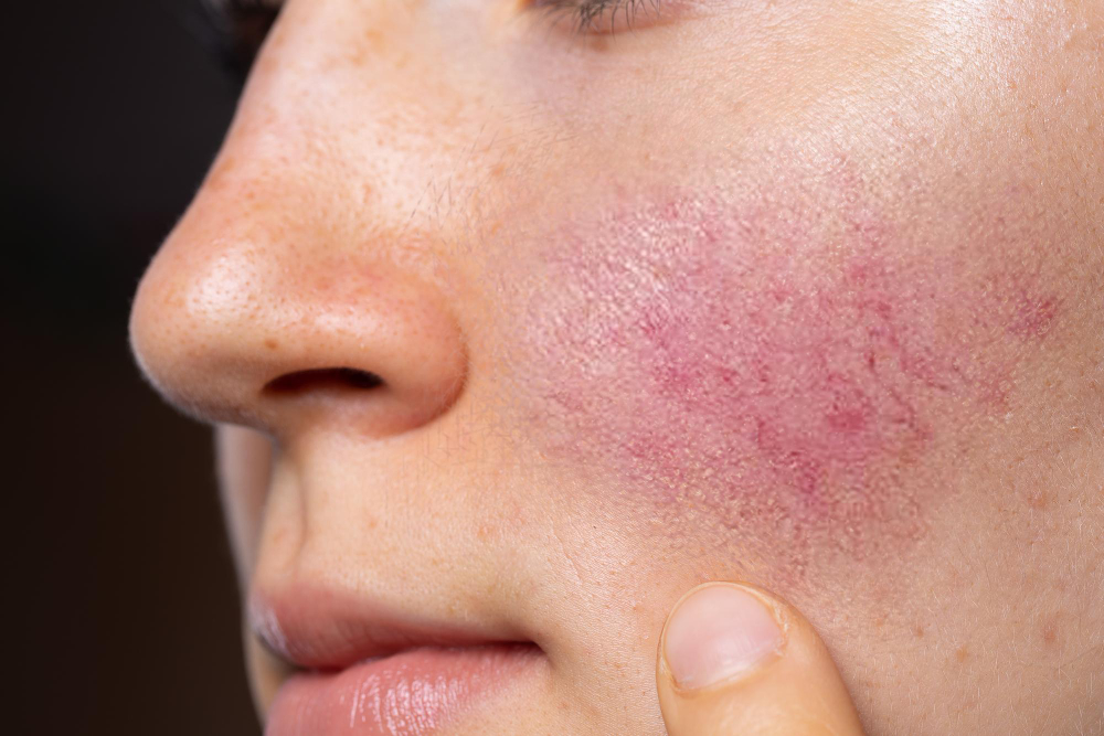V Beam Perfecta laser treatment in Huntington Beach, CA