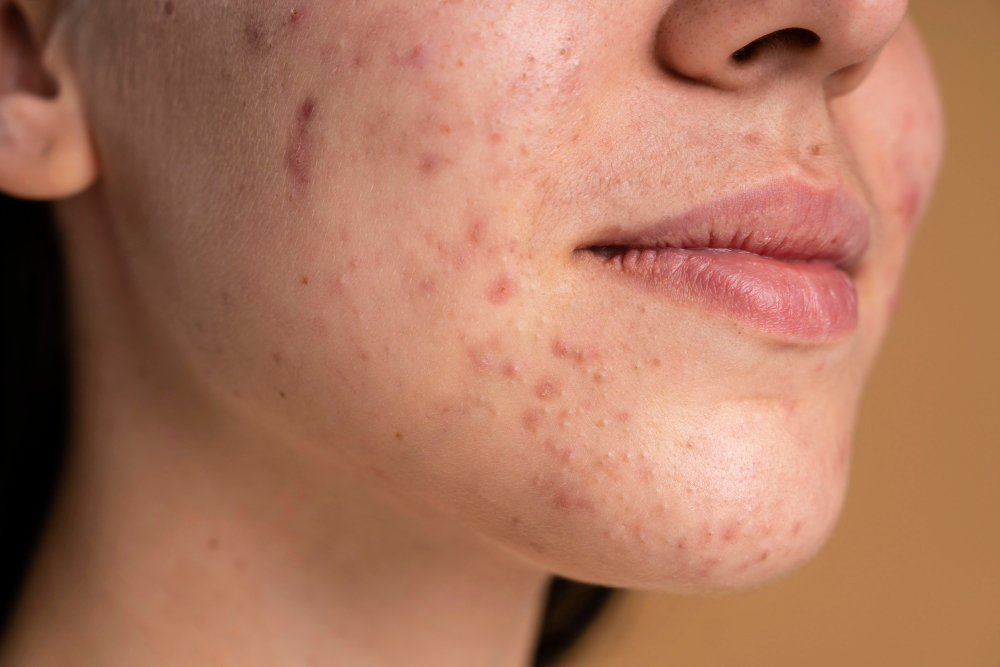 Acne scar treatment in Huntington Beach, CA